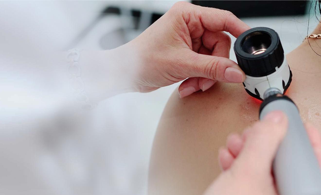 Melanoma SkylineDx